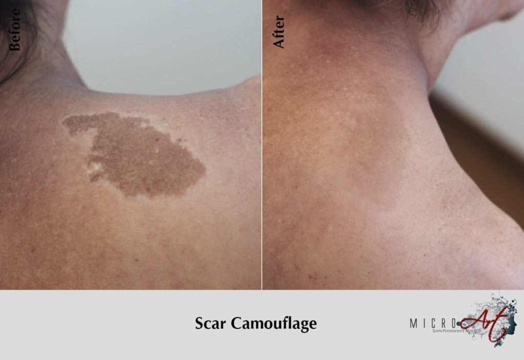 How to get rid of your Lipo Scars? Dark Scar Skin Camouflage