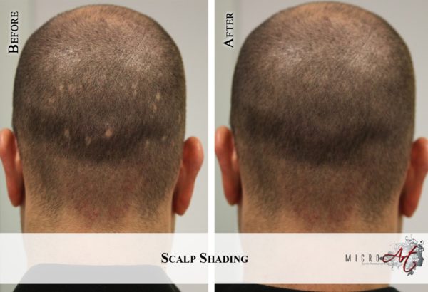 Thinning Hair Solution - MicroArt Semi Permanent Makeup Scalp Shading