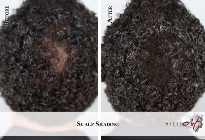 Scalp Micro Pigmentation By MicroArt Semi Permanent Makeup