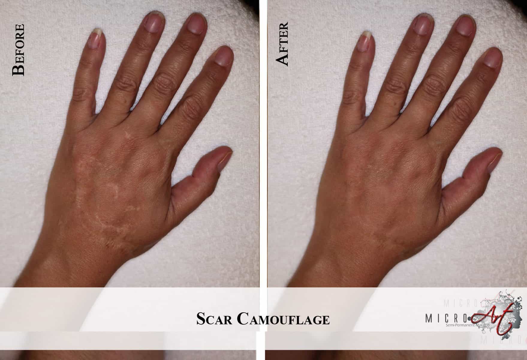 Scar Treatment By MicroArt Semi Permanent Scar Camouflage