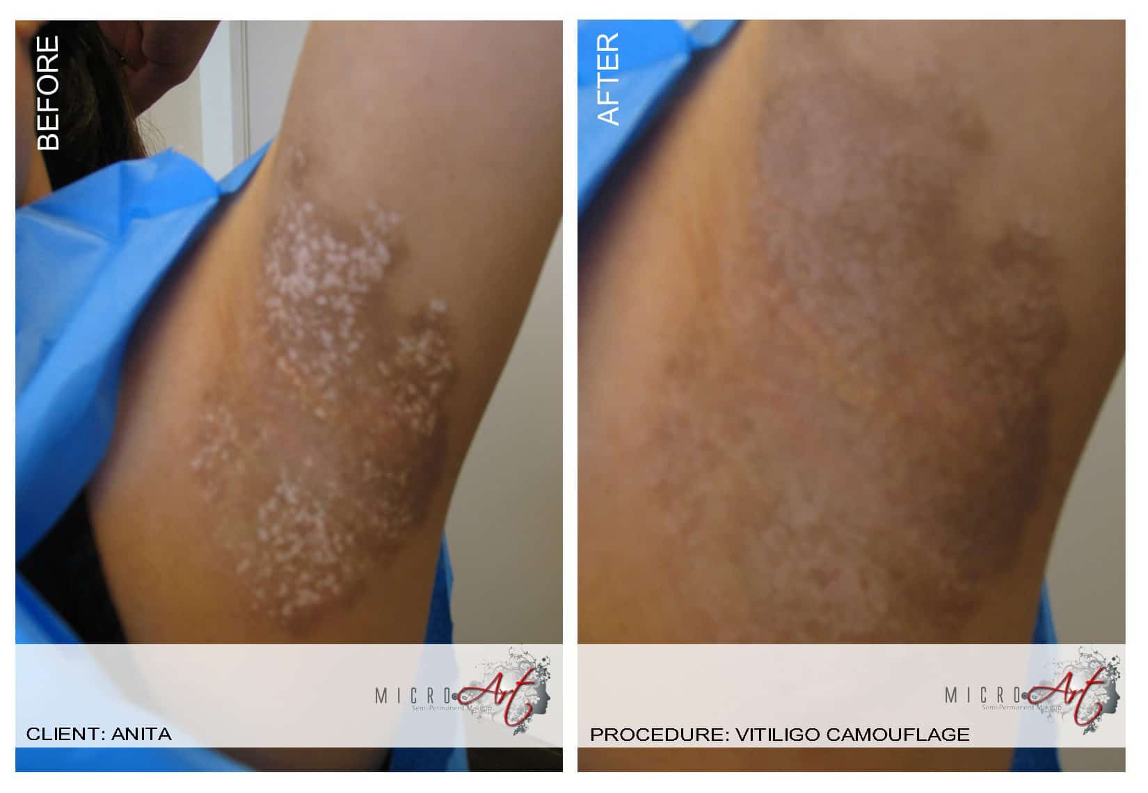 Vitiligo Treatment by MicroArt Semi Permanent Makeup