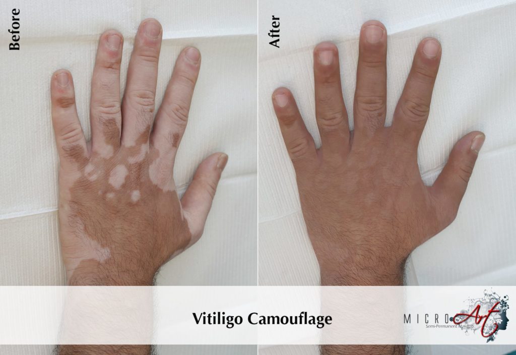 Vitiligo Treatment By Microart Semi Permanent Makeup